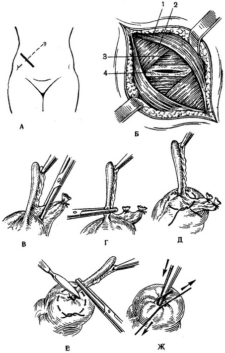 апендектомія
