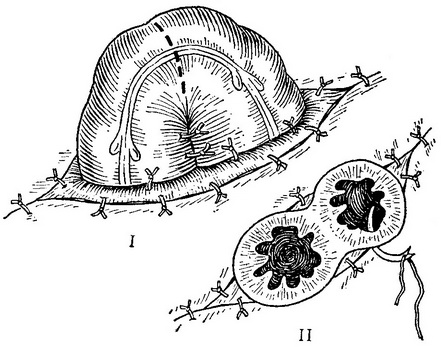 операція освіти штучного заднього проходу по Майдлю