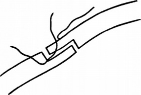 проведення нитки шва при ступенеобразном катарактальном розрізі