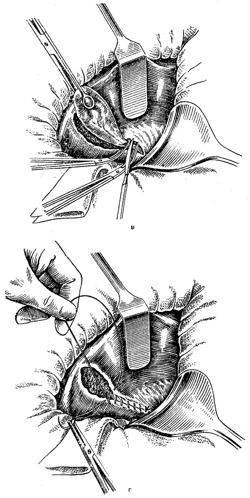 перитонізація ложа жовчного міхура