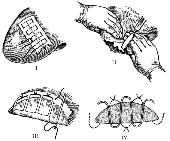 шов печінки