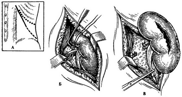 операція видалення нирки