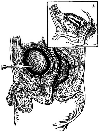 пункція сечового міхура