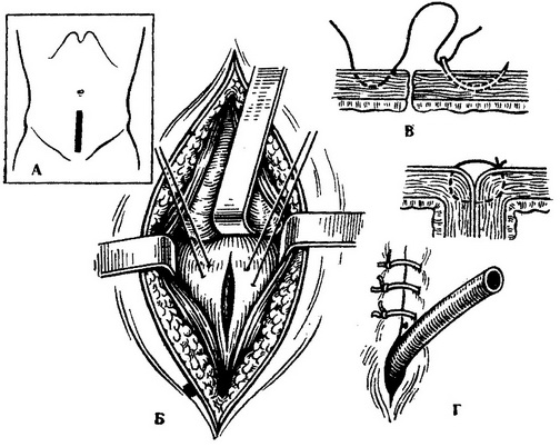 цистотомія