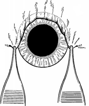 прикриття області операційного розрізу кон'юнктивою