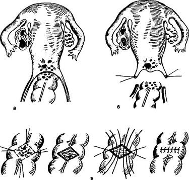 операція позашийкового ендометріозу
