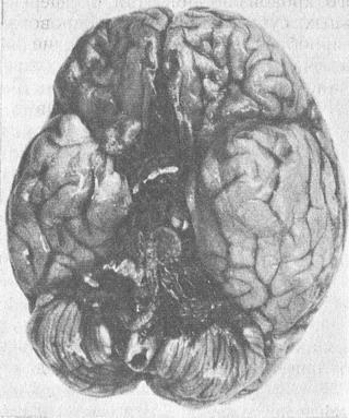 базальное субарахноїдальний крововилив