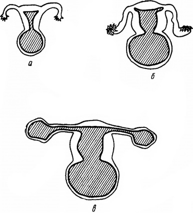 наслідки атрезії дівочої пліви