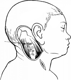 підшкірне введення перфоратора при перфорації наступної голівки