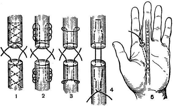 види сухожильного шва