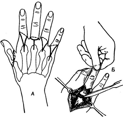 екзартікуляція пальців кисті
