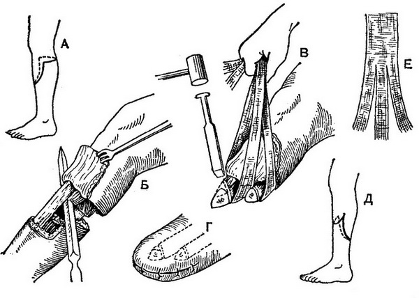 ампутація гомілки клаптевим способом