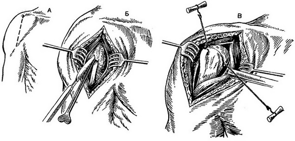 розтин і резекція плечового суглоба