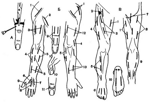 схема розрізів при гнійних процесах на кінцівках
