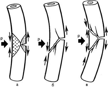 переломи довгих трубчастих кісток