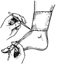 зняття швів з трансплантата