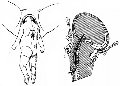спорожнення порожнини черепа від гидроцефалической рідини