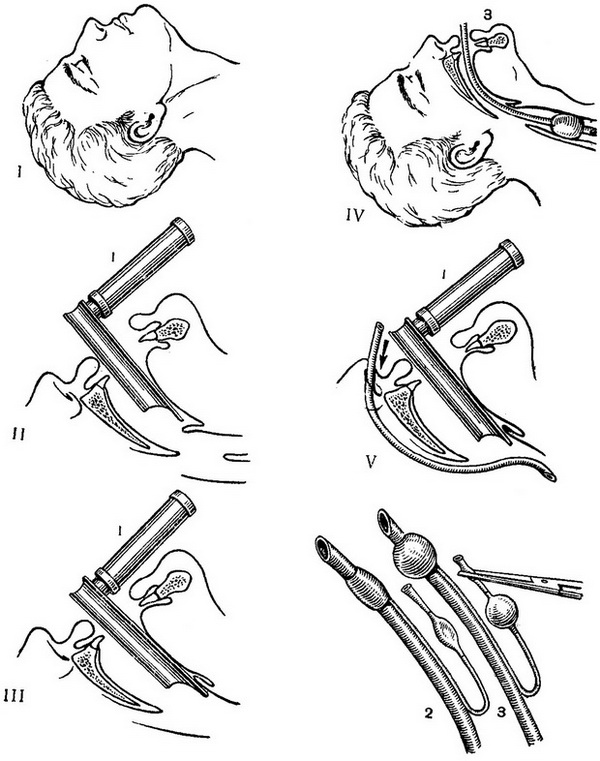 етапи введення интратрахеальной трубки