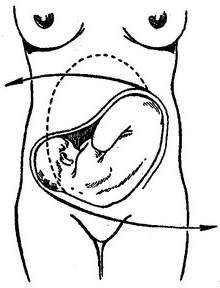 операція повороту плода зовнішніми прийомами при поперечному положенні плоду
