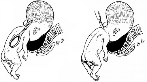 перфорація наступної голівки при гідроцефалії