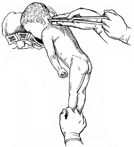 перфорація подальшої головки з боку шийної частини хребта