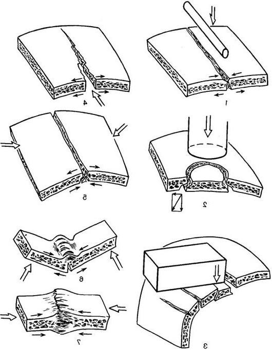 механізм переломів плоских кісток