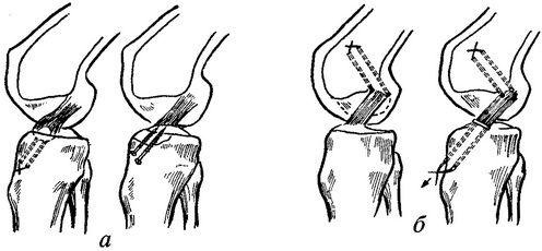 відрив передньої хрестоподібної зв'язки колінного суглоба