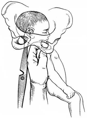 перфорація подальшої головки базиотрибом Тарнье