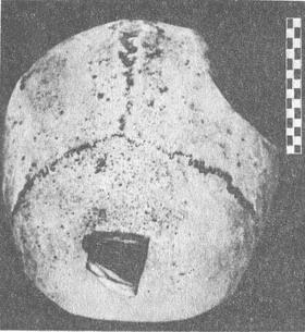 перелом кісток склепіння черепа