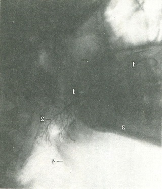 сиалограмма лівої привушної слинної залози