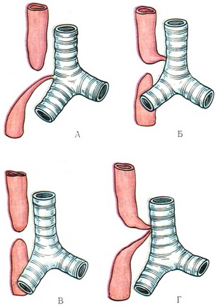 схема аномалій стравоходу