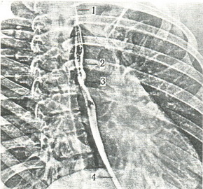 электрорентгенограмма грудної клітини