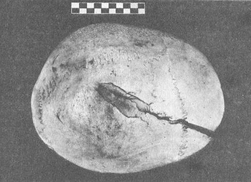 перелом кісток склепіння черепа