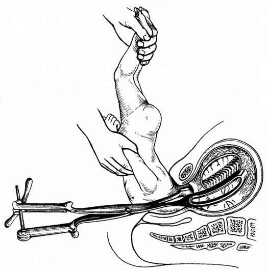 витяг наступної голівки