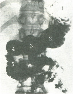рентгенограма шлунка, що має форму рога