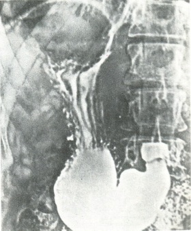 электрорентгенограмма шлунка має форму панчохи