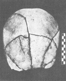 многооскольчатый перелом кісток склепіння черепа