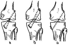 техніка операції по Башкірова