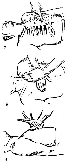 непрямий масаж серця в картинках