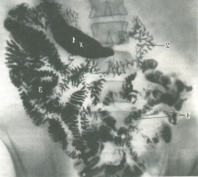 рентгенограма тонкої кишки