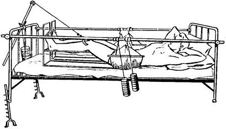 витягування з поясом Гильфердинга при переломах кісток тазу зі зміщенням відламків