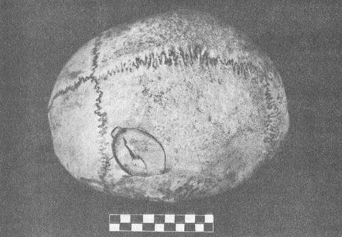 вдавлений перелом кісток склепіння черепа