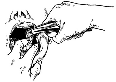 видалення зуба на лівій половині нижньої щелепи