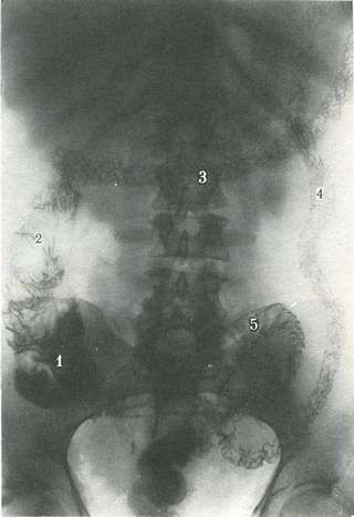 рентгенограма рельєфу внутрішньої поверхні товстої кишки