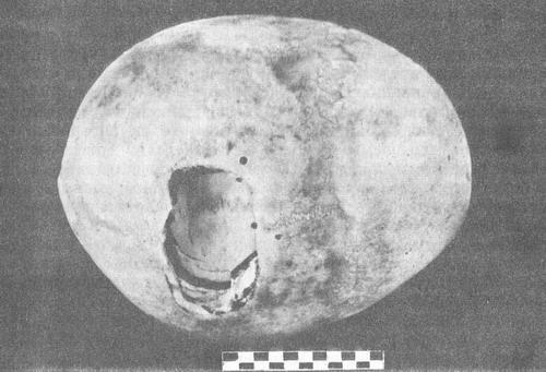 террасовидный перелом кісток склепіння черепа