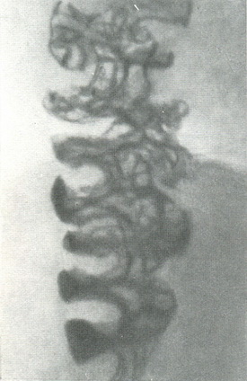 знімок рельєфу внутрішньої поверхні висхідної товстої кишки