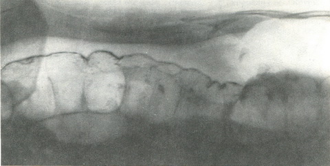 рентгенограма низхідного відділу товстої кишки