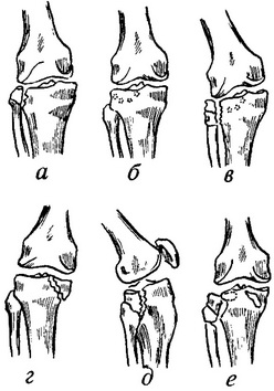 види переломів виростків великогомілкової кістки
