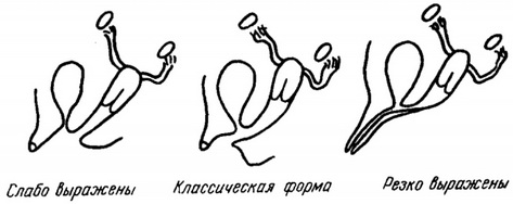 соматическо-статеві зміни при адреногенітальному синдромі