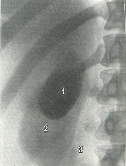 передній знімок жовчного міхура при холецистографії